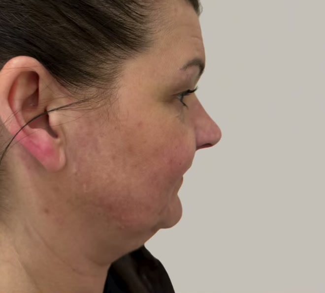 Client in profile before a mid and lower face COG thread lift